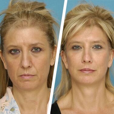 Natalia de Kyivs Erfahrung, Foto vor und nach der Verwendung von Intenkin